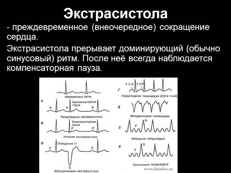 Экстрасистола - преждевременное (внеочередное) сокращение сердца.  Экстрасистола прерывает доминирующий (обычно синусовый) ритм. После